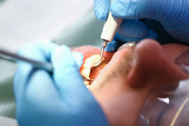 Best Emergency Dental Care for Broken or Chipped Teeth in Goulding, FL