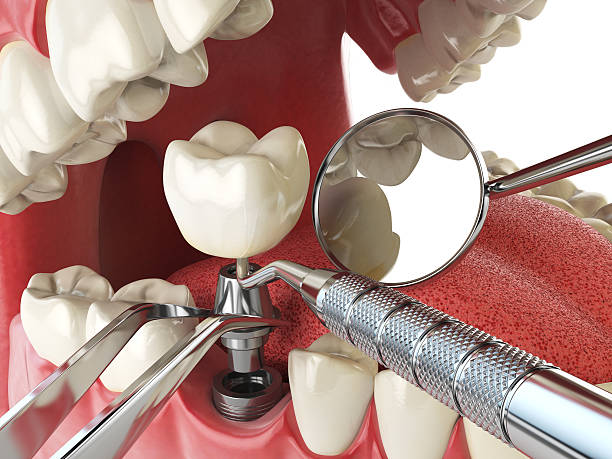 Best Emergency Denture Repair in Goulding, FL